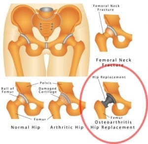 Hip joint. Arthritic Hip. Hip fracture
