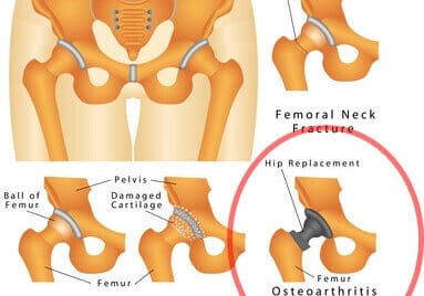Hip joint. Arthritic Hip. Hip fracture
